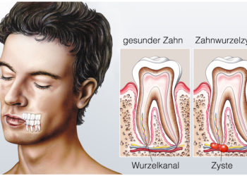 Gesunder Zahn.Zahnwurzelzyste