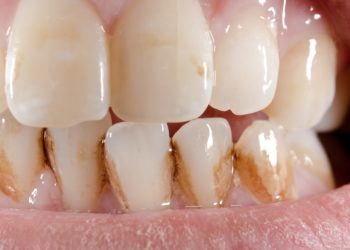 Deutsche Forscher haben den lange vermuteten Zusammenhang zwischen Zahnfehlstellungen und Zahnfleischerkrankungen genauer untersucht. (Bild: Michael Tieck/fotolia.com)