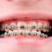 Gesundheitsexperten zufolge ist das regelmäßige Tragen einer Zahnspange die Grundlage für die Behandlung schiefer Zähne. Wie sinnvoll diese kieferorthopädische Behandlung aber wirklich ist, ist derzeit umstritten. (Bild: jonnysek/fotolia.com)