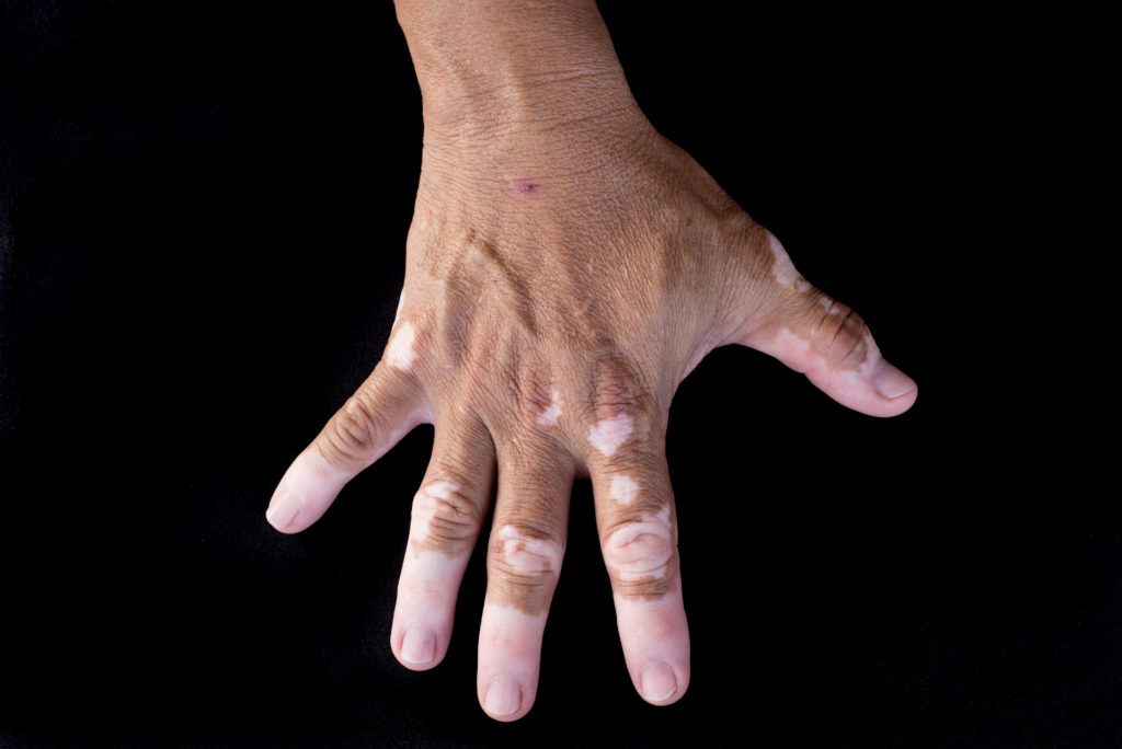 Quadrichrome vitiligo is another variant of vitiligo (on hand)