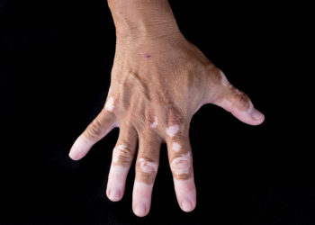 Quadrichrome vitiligo is another variant of vitiligo (on hand)