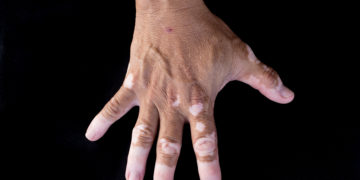 Quadrichrome vitiligo is another variant of vitiligo (on hand)