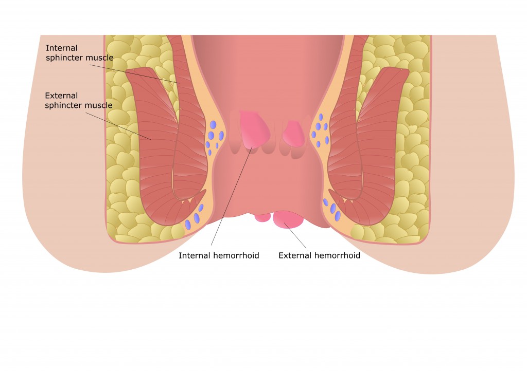 Hämorrhoiden