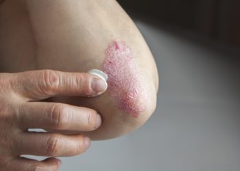 Eine Schuppenflechte ist derzeit nicht heilbar. Doch es steht eine Vielzahl moderner Behandlungsmethoden zur Verfügung, um die Symptome der Hautkrankheit zu behandeln. (Bild: hriana/fotolia.com)