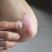 Eine Schuppenflechte ist derzeit nicht heilbar. Doch es steht eine Vielzahl moderner Behandlungsmethoden zur Verfügung, um die Symptome der Hautkrankheit zu behandeln. (Bild: hriana/fotolia.com)