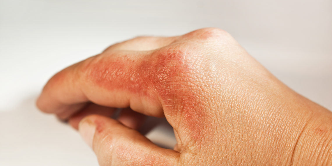 Oft sind Kontaktallergien für den juckenden Hautausschlag verantwortlich. (Bild: Sonja Birkelbach/fotolia)