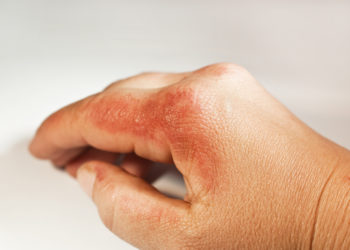 Oft sind Kontaktallergien für den juckenden Hautausschlag verantwortlich. (Bild: Sonja Birkelbach/fotolia)