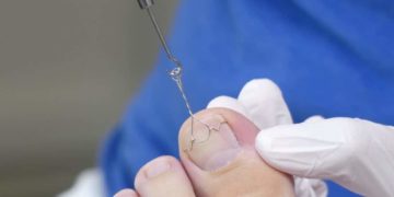 Nagelspange, Orthonyxiespange bei einem eingewachsenen Zehennagel. (Bild: Maria/fotolia.com)