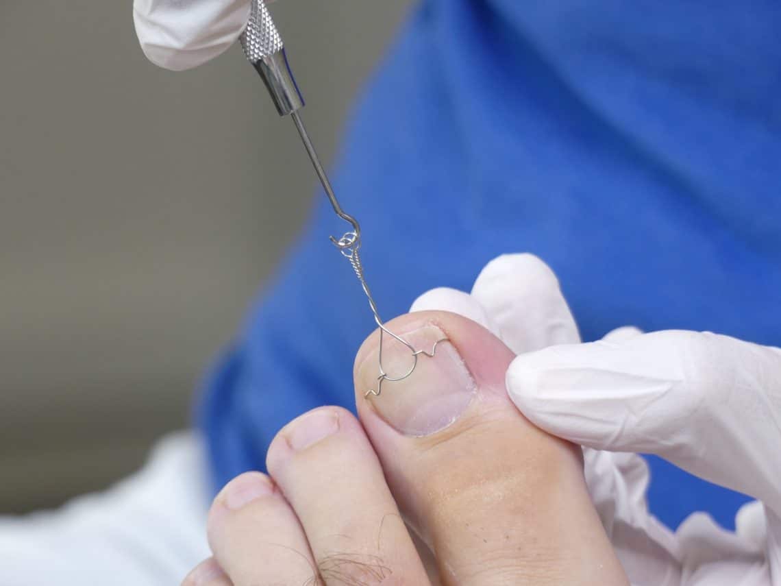 Unterm fingernagel eiter Nagelbettentzündung Behandlung: