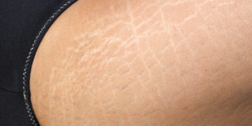 Dehnungsstreifen treten vor allem am Bauch, an den Beinen, am Po und an der Brust auf. (Bild: Drivepix/stock.adobe.com)