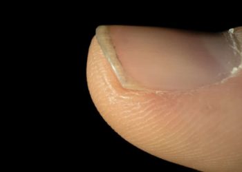 Brüchige Fingernägel können unangenehm sein und unter Umständen auch eine krankheitsbedingte Ursache haben. (Bild: iCreations.de/fotolia.com)
