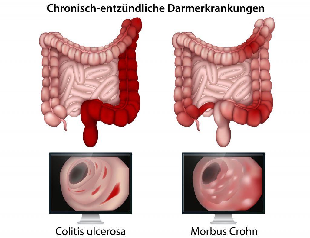 Die genauen Ursachen der Darmerkrankungen Morbus Crohn und Colitis ulcerosa sind bis heute nicht geklärt. (Bild: bilderzwerg/fotolia.com) 