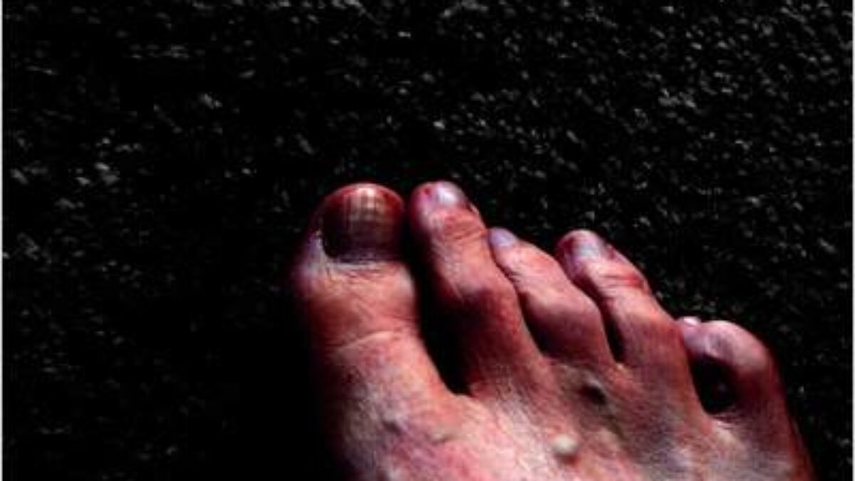 Ruckkehr Der Syphilis Krankheit In Deutschland Heilpraxis