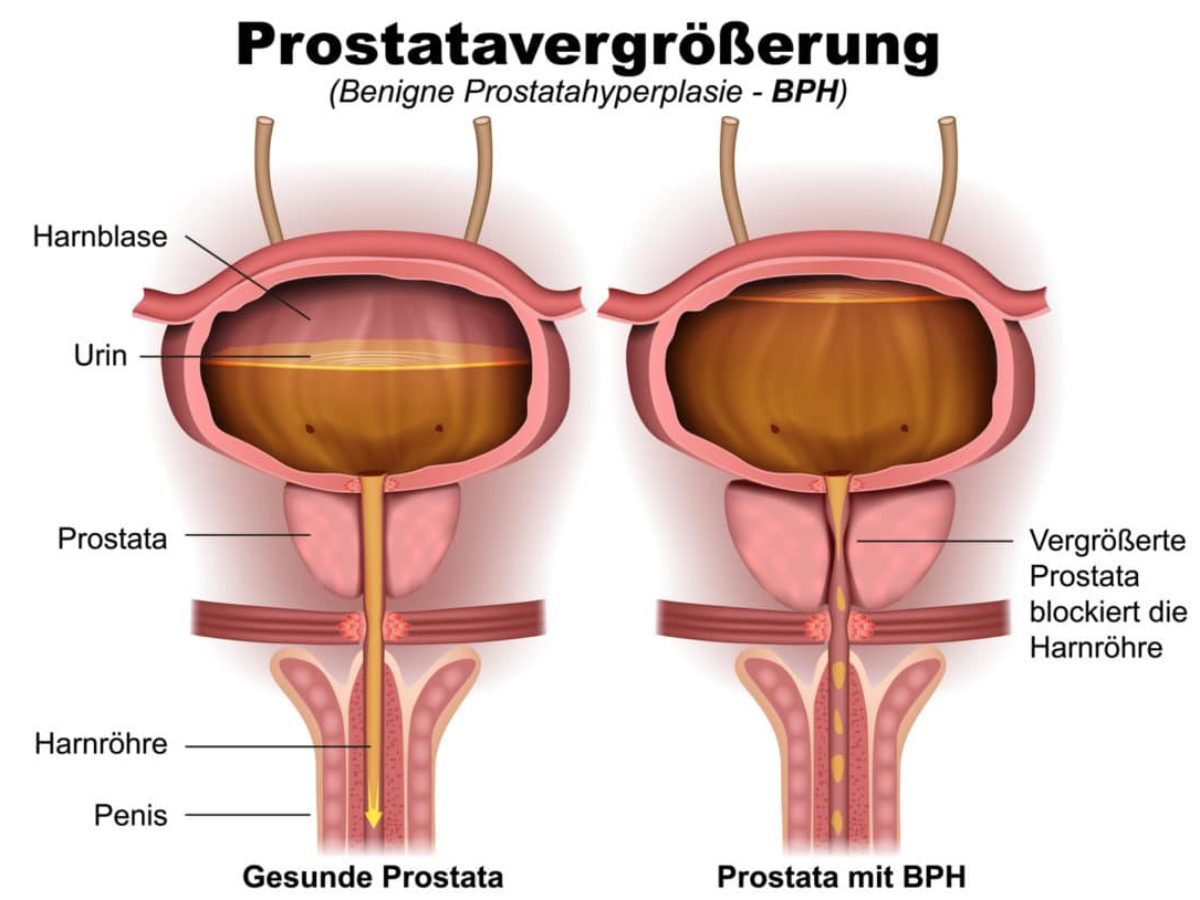 prostata schrumpfung)