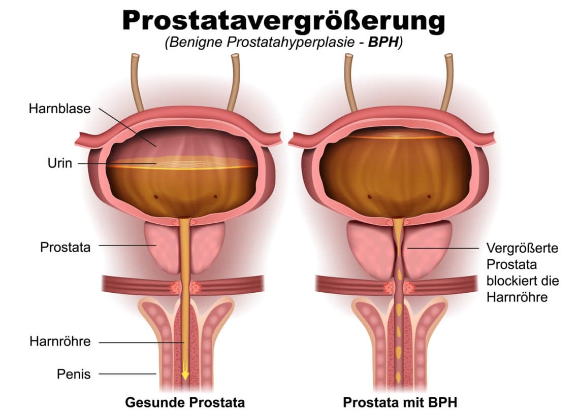 Benigne prostatahyperplasie symptome