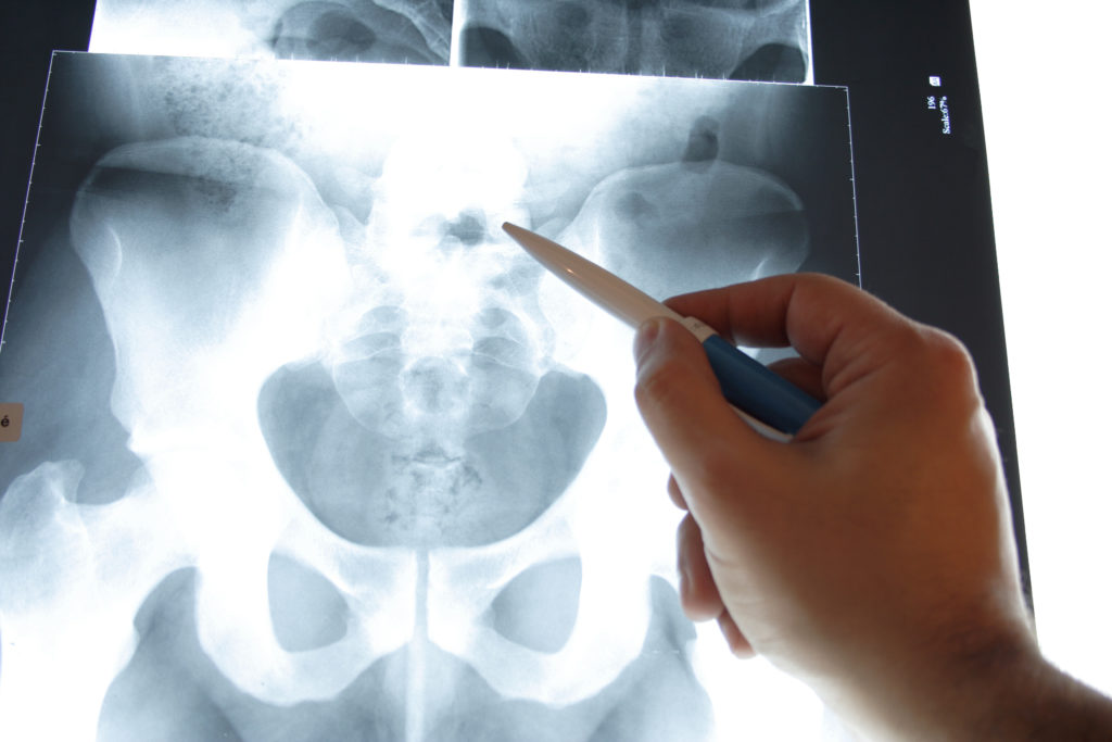 Beckenschmerzen sind oft auf Beeinträchtigungen der Knochenstruktur des Beckengürtels zurückzuführen. (Bild: luxpainter/fotolia.com)