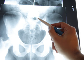 Beckenschmerzen sind oft auf Beeinträchtigungen der Knochenstruktur des Beckengürtels zurückzuführen. (Bild: luxpainter/fotolia.com)