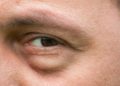 Eine zu kurze Nacht oder viel Alkohol am Vorabend machen sich schnell durch geschwollene Augen am Morgen erkennbar. (Bild: Catalin Pop/stock.adobe.com)