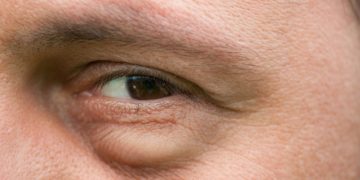 Eine zu kurze Nacht oder viel Alkohol am Vorabend machen sich schnell durch geschwollene Augen am Morgen erkennbar. (Bild: Catalin Pop/stock.adobe.com)