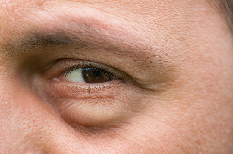 Auge beule im Die häufigsten