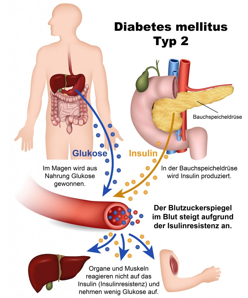 diabetes mellitus definition auf deutsch