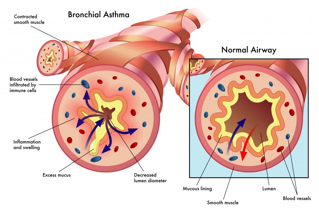 Was passiert bei Asthma?