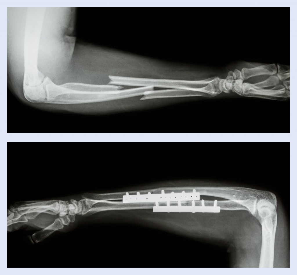 Fracture ulnar and radius (Forearm bone) and surgery