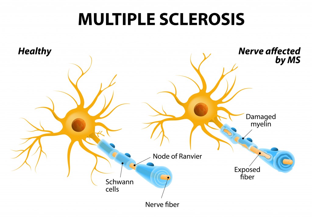 Multiple sclerosis or MS. autoimmune disease. the nerves of the brain and spinal cord are damaged by one’s own immune system that affects the brain and spinal cord resulting in loss of muscle control, vision and balance.