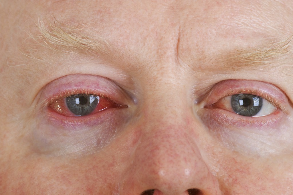 Jucken und rote Augen sind die Leitsymptome bei einer Bindehautentzündung. (Bild: Birgit Reitz-Hofmann/fotolia)