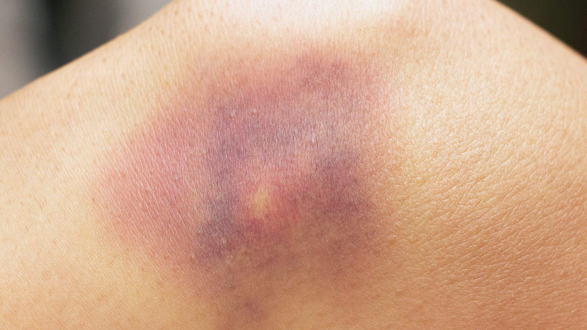 Der an blaue hand flecken Blaue Flecke