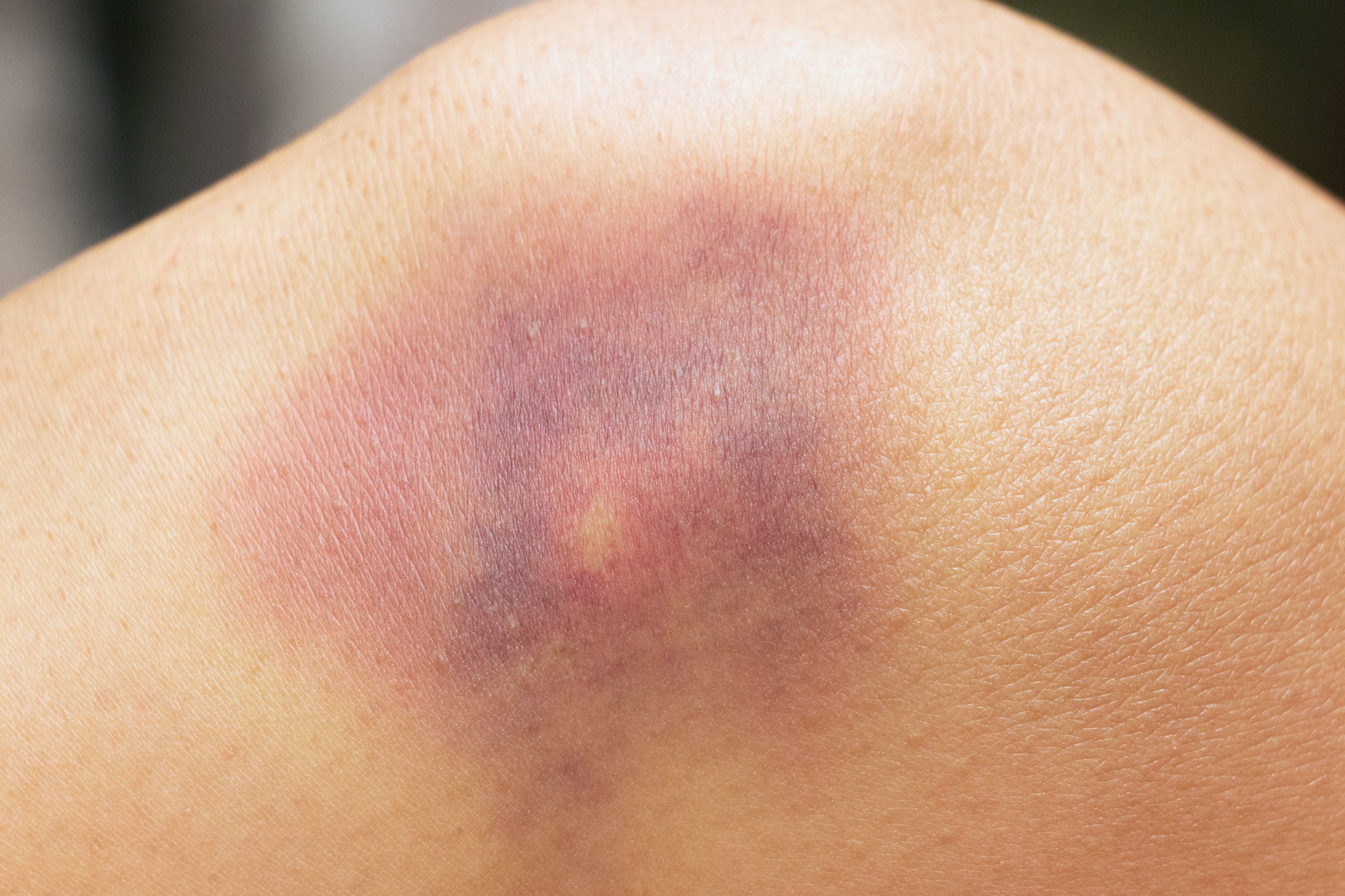 Bluterguss: Wann sind blaue Flecken gefährlich? 