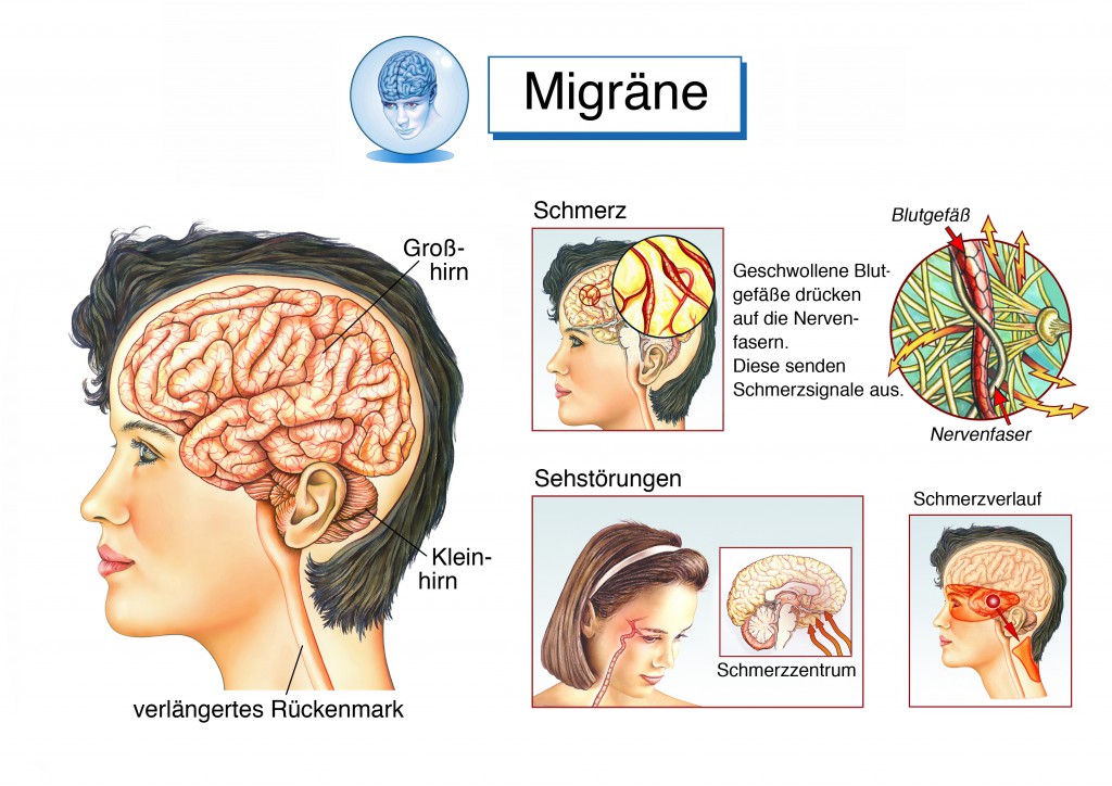 Häufig steckt hinter Stirnschmerzen eine Migräne. (Henrie/fotolia)