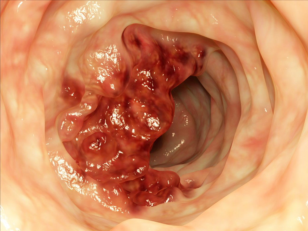 Darmtumor / intestine tumor