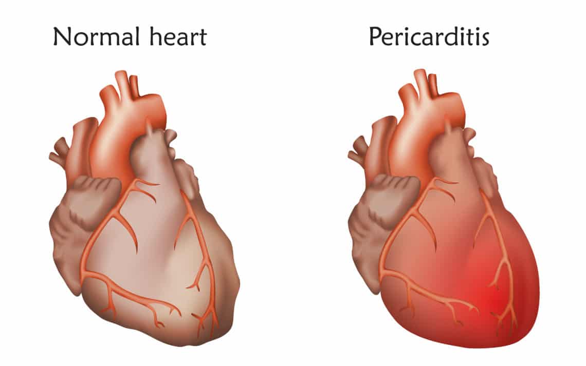 Auf der linken Seite ist ein gesundes Herz abgebildet. 
