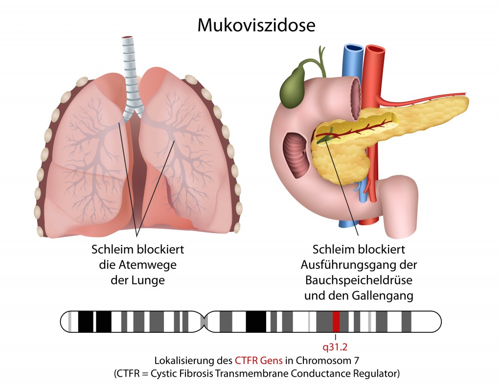 Mukoviszidose, zystische Fibrose, Erklrung deutsch