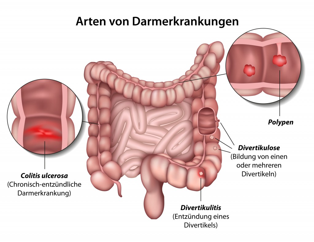 Divertikel entzündung