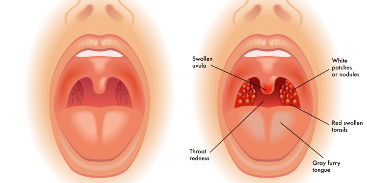 Und geschwollen taub lippe Aufwachen mit