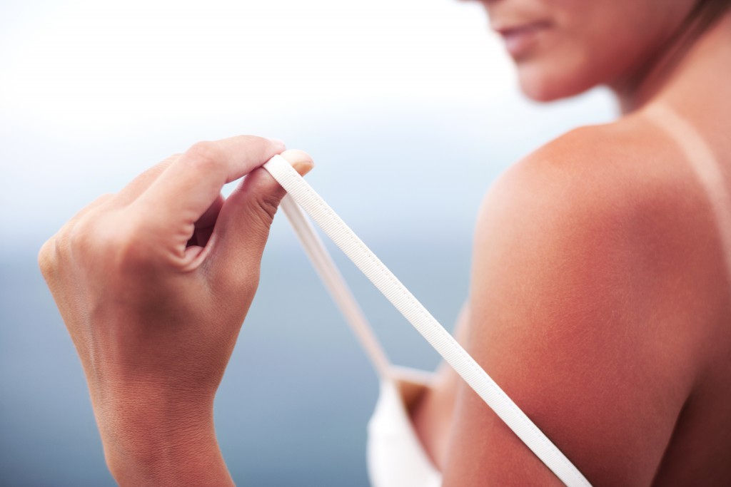 Hausmittel können die Beschwerden von einem Sonnenbrand lindern und auch das Absterben der Hautzellen abmildern. (Bild: Markomarcello - fotolia)