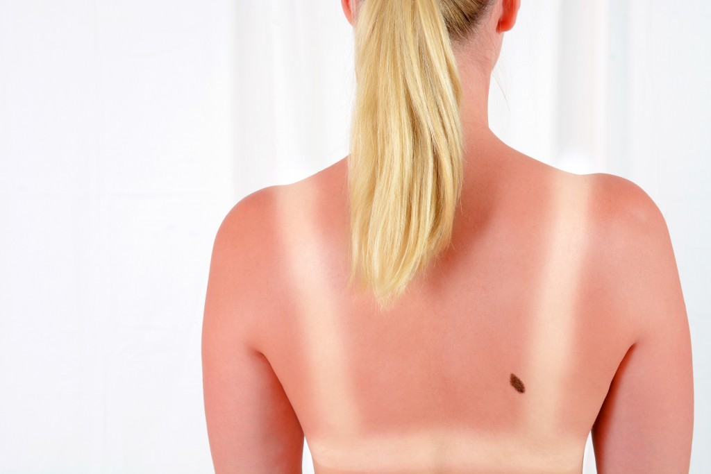 Jeder Sonnenbrand schadet der Haut und erhöht das Risiko von Hautkrebs. (Bild: Dan Race - fotolia)