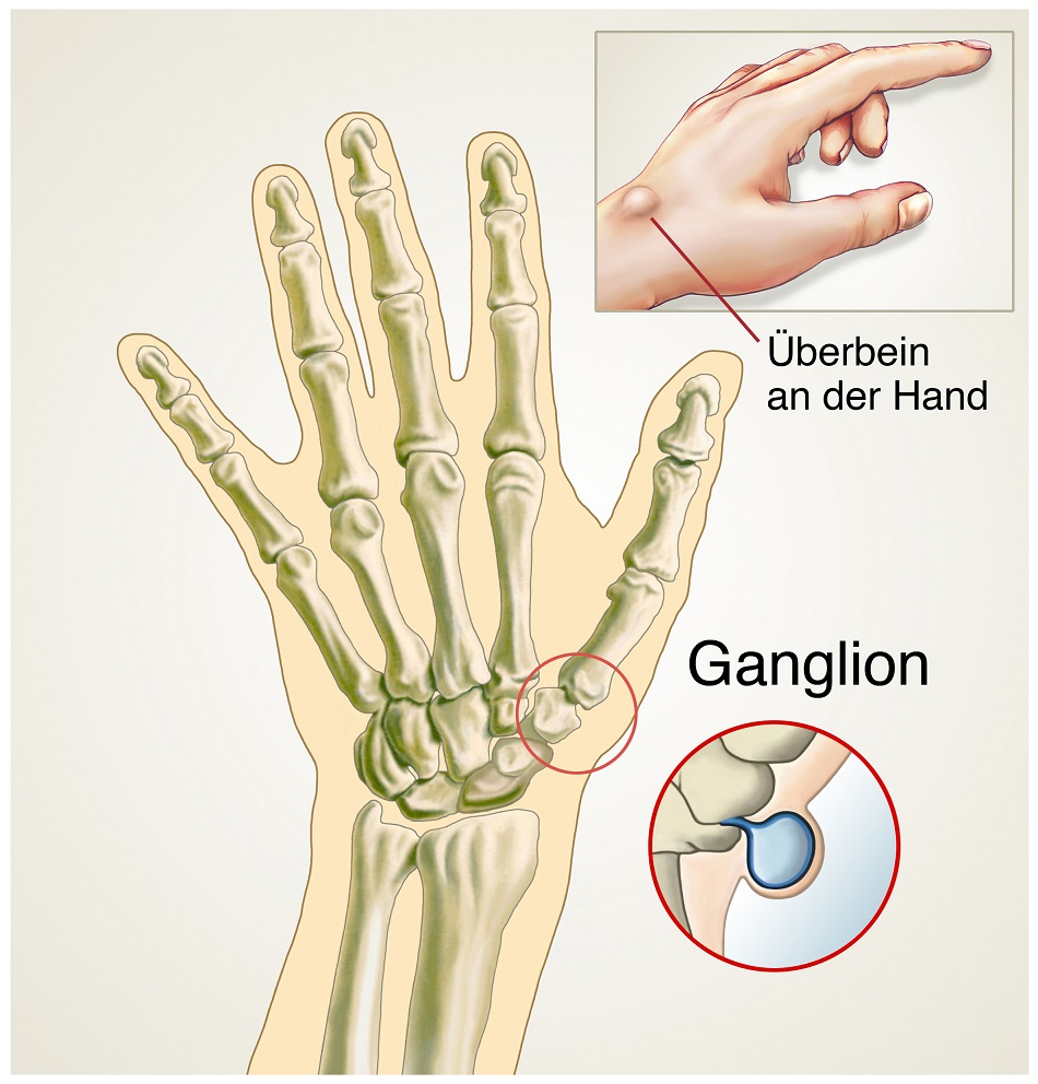 Ein Überbein an der Hand kann oft Schmerzen verursachen. Bild: Henrie - fotolia