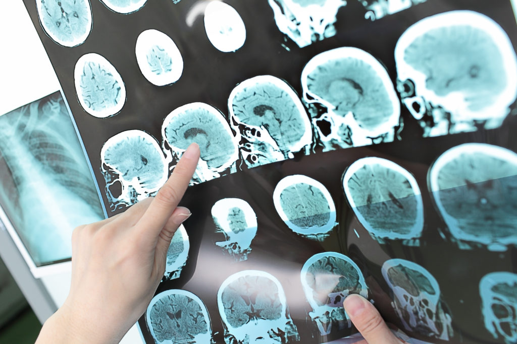 Die Behandlung von Hirntumoren könnte durch Lasertechnik deutlich verbessert werden. (Bild: sudok1/fotolia.com)