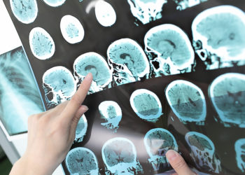 Die Behandlung von Hirntumoren könnte durch Lasertechnik deutlich verbessert werden. (Bild: sudok1/fotolia.com)