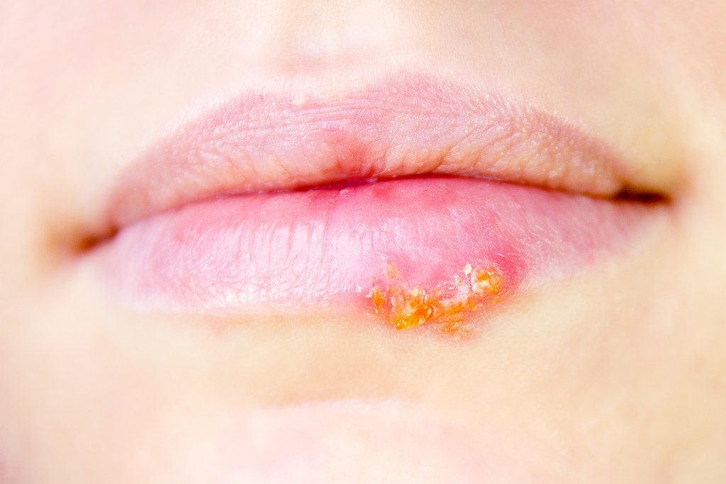 Bei Berührung der Lippenherpes-Bläschen droht eine Übertragung der Erreger. (Bild: Ekaterina/fotolia.com)