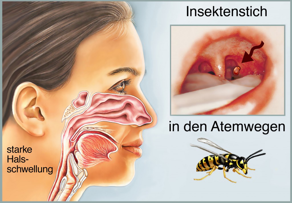 Ursache für das Engegefühl kann ein Insektenstich im Hals- bzw. Rachenbereich sein. In diesem Fall muss sofort ein Arzt aufgesucht werden, um eine lebensbedrohliche Verengung der Atemwege zu vermeiden. (Bild: Henrie/fotolia.com)
