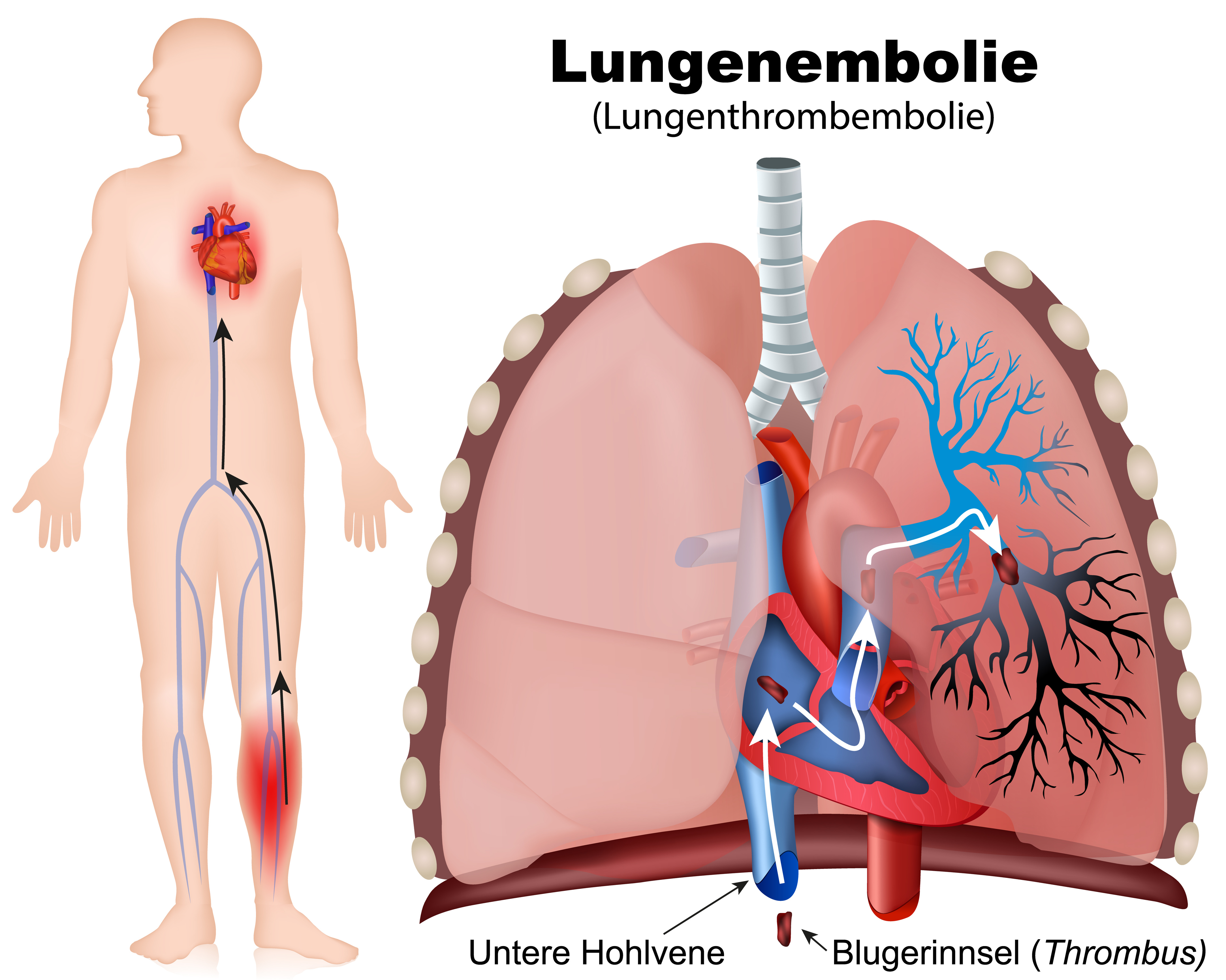 Оторвался тромб в легких. Тромбоэмболия легочной артерии. Тромбоэмболия легочной артерии (Тэла). 1. Тромбоэмболия лёгочной артерии. Тромбоэмболия а8 легочной артерии.