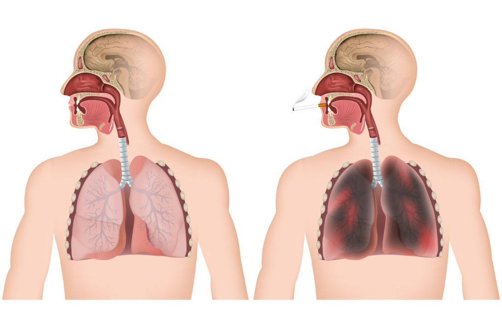 Schädigungen der Lunge durch Jahrelanges Rauchen. Bild:  bilderzwerg - fotolia