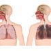 Schädigungen der Lunge durch Jahrelanges Rauchen. Bild:  bilderzwerg - fotolia