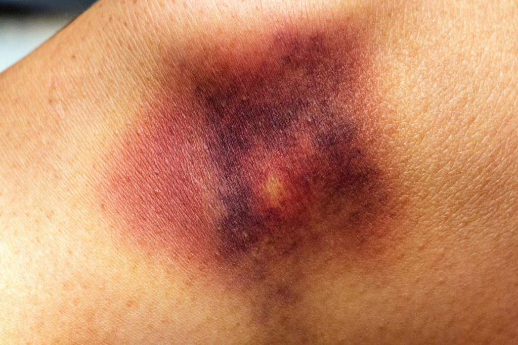 Blaue Flecken Welche Hämatome unbedenklich sind und welche ärzlich