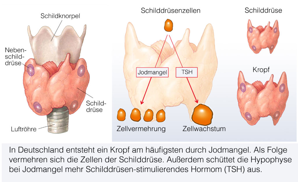 Folgen des allgemeinen Jodmangels. Bild: Henrie - fotolia