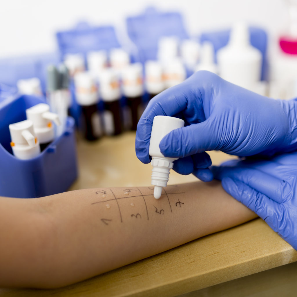 Allergy - skin prick tests